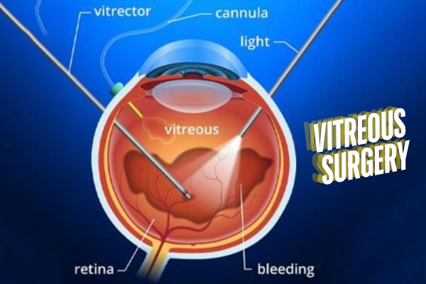 Vitreous surgery